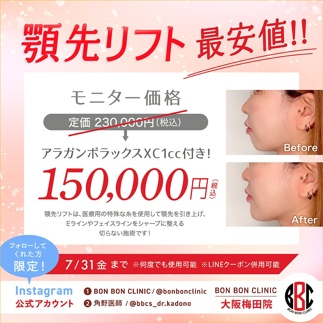 顎先リフトのクーポン画像