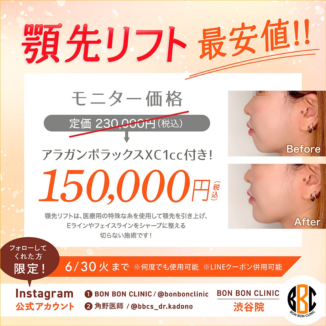 顎先リフトのクーポン画像