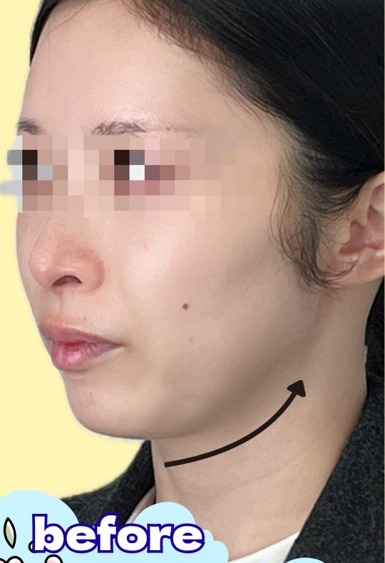 症例写真:脂肪吸引&糸リフトの施術前