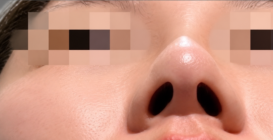 症例写真:ヒアルロン酸の施術後01