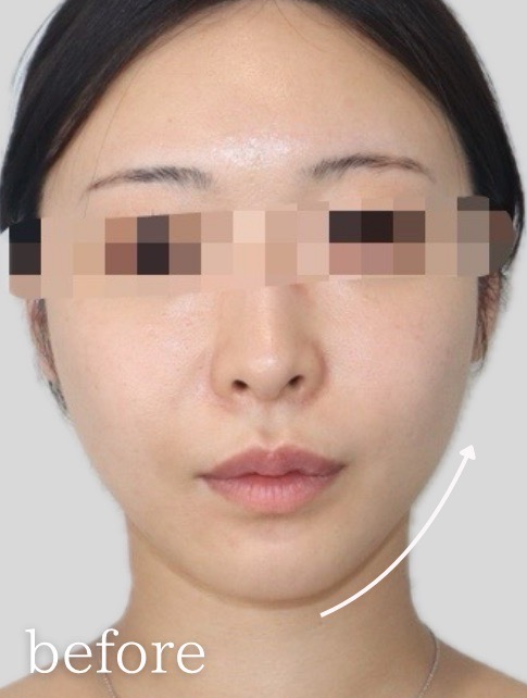 症例写真:糸リフトの施術前01