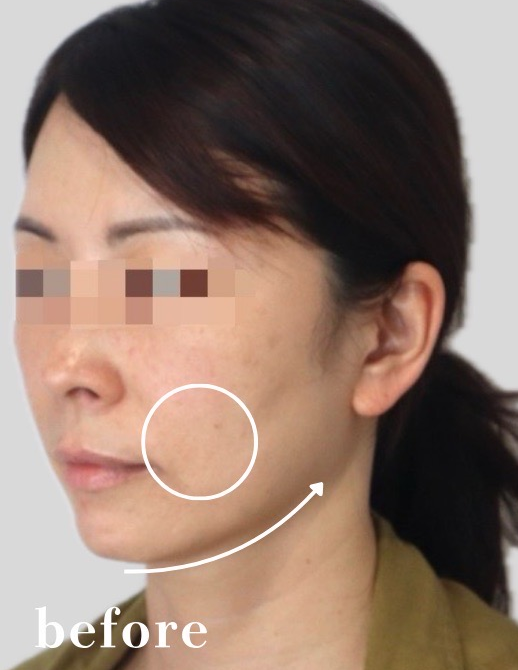 症例写真:糸リフトの施術前03