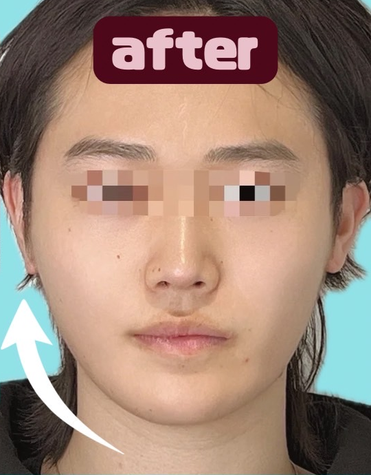 症例写真:糸リフトの施術後04