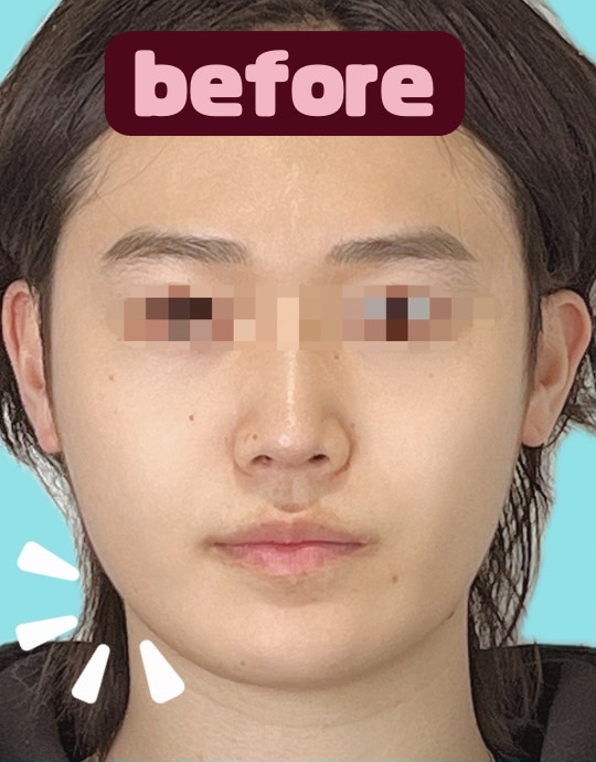 症例写真:糸リフトの施術前04
