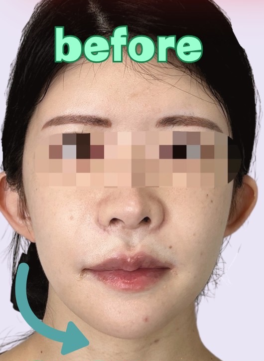 症例写真:糸リフトの施術前05