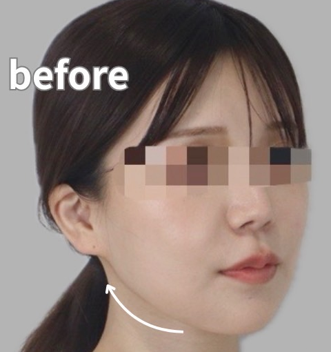 症例写真:糸リフトの施術前06