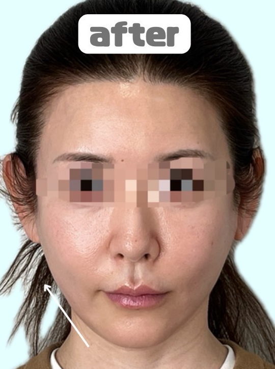 症例写真:糸リフトの施術後07