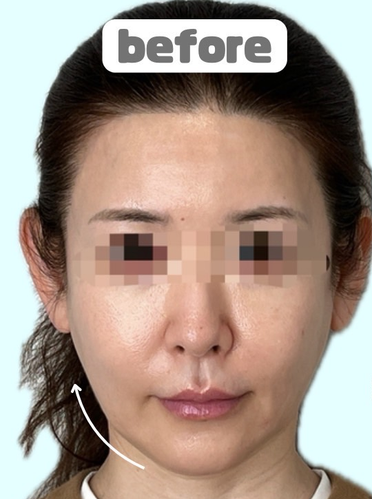 症例写真:糸リフトの施術前07