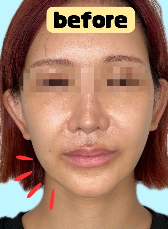 症例写真:糸リフトの施術前08