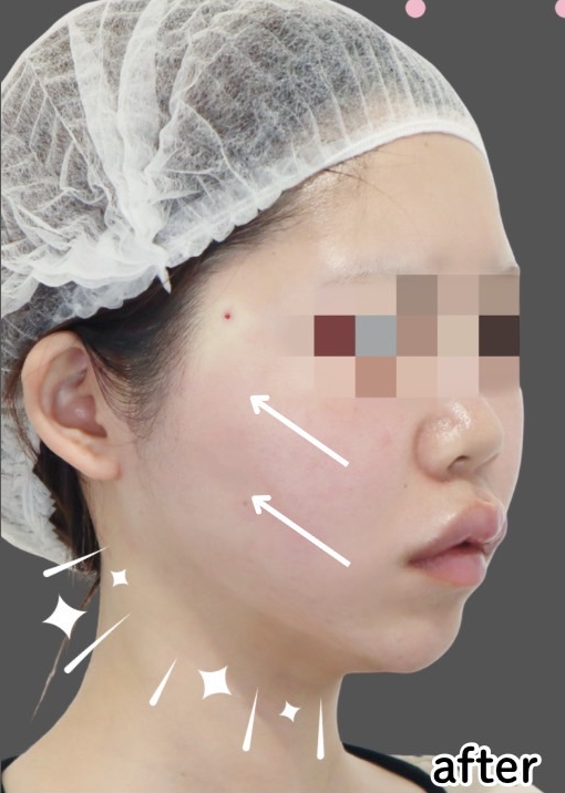症例写真：糸リフトの施術後02