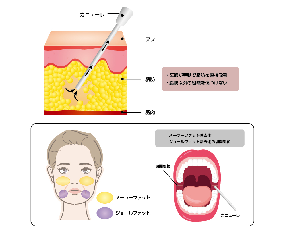 小顔脂肪吸引ならボンボンクリニック